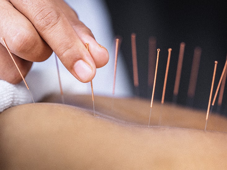 ACUPUNCTURE